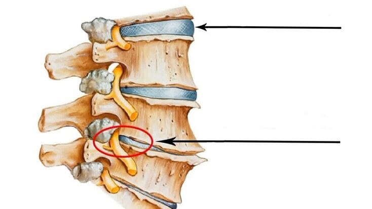 lesione spinale in caso di osteocondrosi cervicale