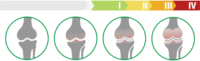 Stadi clinici dell'artrosi dell'articolazione del ginocchio (grado di artrosi dell'articolazione del ginocchio)
