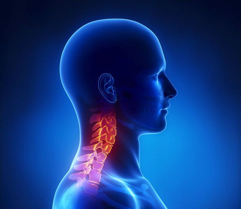 L'osteocondrosi cervicale è una patologia della colonna vertebrale, di cui puoi liberarti a casa