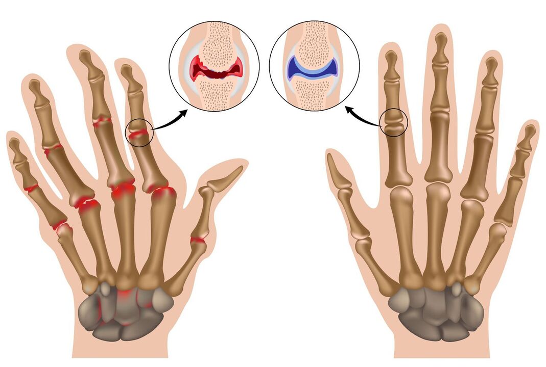 Articolazioni della mano sane e affette da poliartrite