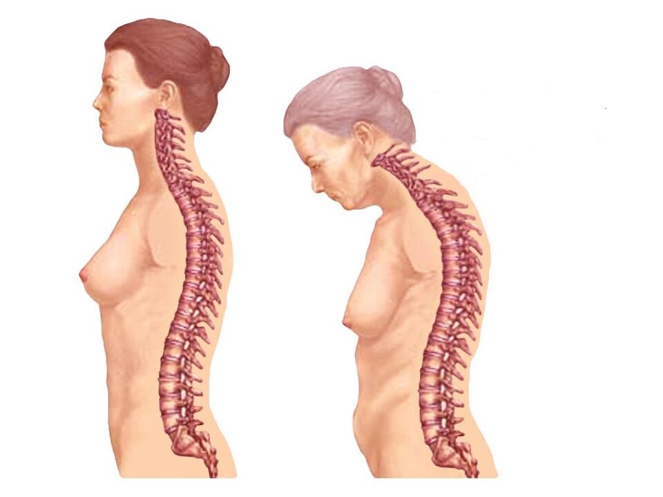 colonna vertebrale curva sana con osteocondrosi
