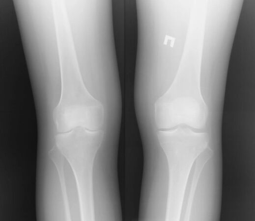 La radiografia dell'articolazione del ginocchio