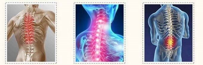 Lesioni spinali dell'osteocondrosi