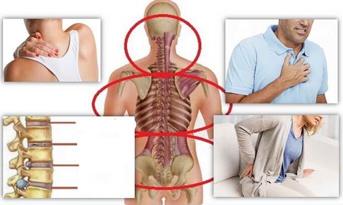Luoghi di malattia per osteocondosi