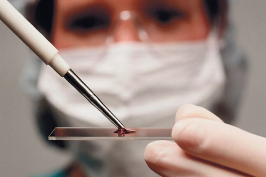 L'artrite è una malattia infiammatoria e la sua presenza viene rivelata dagli esami del sangue.