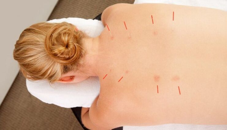 Agopuntura per l'osteocondrosi toracica, che presenta molti vantaggi