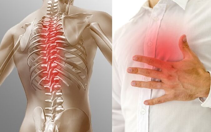 L'osteocondrosi toracica si manifesta con dolore e sensazione di oppressione al petto